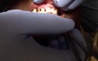 Gold Anterior Crown Occlusion Check