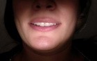 Apical Molar Surgery - Patient Perspective