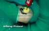 Extreme root canal anatomy - how to deal with