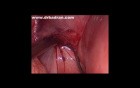 Laparoscopic Cervical Cerclage