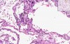 Lung, Kidney - Metastatic Calcification