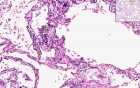 Lung, Kidney - Metastatic Calcification