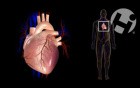 Ventricular Fibrillation