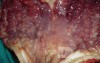 Endoscopy of Scirrhous Gastric Carcinoma involving the entire Fundus, Body and the Antrum (38 of 47)