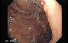 Multiple Gastric Angiodysplasia (2 of 17)