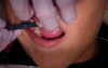 Orthodontic Band Seating 101