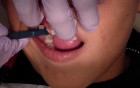 Orthodontic Band Seating 101