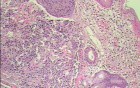 Gastric Carcinoid tumor (7 of 8)