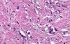 Adenocarcinoma - Histopathology  - Esophagus