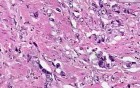 Adenocarcinoma - Histopathology  - Esophagus