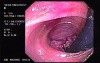 Rectal Endoscopy - Adenocarcinoma (2 of 3)