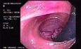 Rectal Endoscopy - Adenocarcinoma (2 of 3)