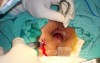 Fistula in Ano (6 of 7)