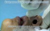 Bloodless Rhinoplasty