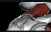 Rotator Cuff Surgery