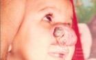 Haemangioma Of The Nose