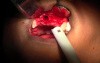 Membrane Preparation & Decortication - Maxillary Bone Grafting #7-8-10 Sites
