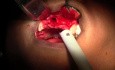 Membrane Preparation & Decortication - Maxillary Bone Grafting #7-8-10 Sites
