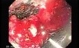 Endoscopic Resection of Giant Tubulo-Villous of the rectum (16 of 35)