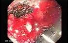 Endoscopic Resection of Giant Tubulo-Villous of the rectum (16 of 35)