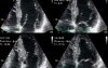 Rapid Atrial Fibrillation Dobutamine Induced
