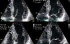 Rapid Atrial Fibrillation Dobutamine Induced