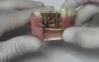 Implant Crown & Bridge - Model Demonstration