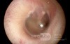 The Normal Eardrum