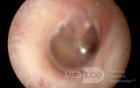 The Normal Eardrum