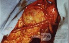 Venous Coronary Artery Bypasses