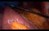 Laparoscopic Gastric Bypass - Part 2