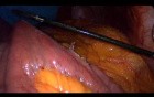 Laparoscopic Gastric Bypass - Part 2