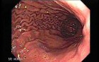 Gastric Folds 2