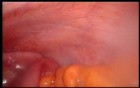Colonic Perforation With Peritonitis - Laparoscopy (32 of 46)