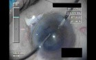 Swollen Conjunctiva - Part 4