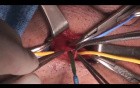 Varicocelectomy - Bilateral Approach