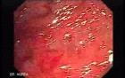 Multiple Rectal Ulcers (2 of 110)
