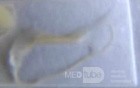 Colonoscopy observing a trichuris in the cecum (8 of 8)