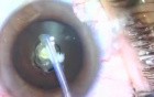 Fugo Blade Nanotechnology - plasma ablation