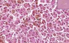 Hemochromatosis-hemosider - Histopathology - Liver, lymph node 