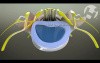 Lumbar Radiculopathy