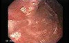 Early Gastric Adenocarcinoma - Endoscopy (1 of 5)