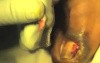 Stage-3 Ingrown Toenail: SilverNitrate.mov