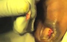 Stage-3 Ingrown Toenail: SilverNitrate.mov