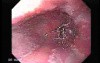 Barrett's Esophagus of long segment (2 of 11)