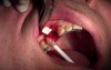 Extraction #5 with Socket Bone Grafting - d-PTFE