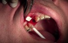 Extraction #5 with Socket Bone Grafting - d-PTFE