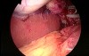 SILS cholecystectomy