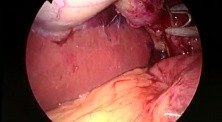 SILS cholecystectomy