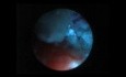 Staghorn Kidney Stone - PCNL
